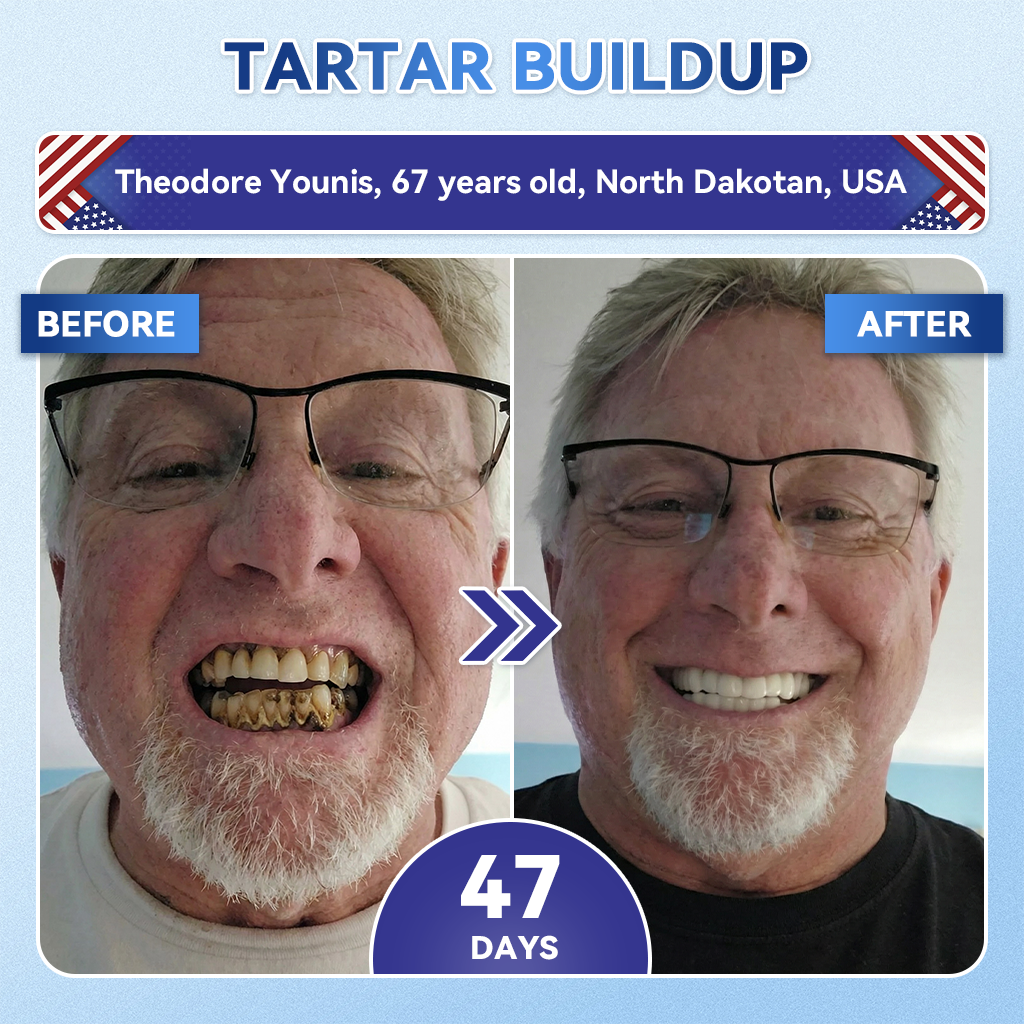 Your Smile~ SpringCherry® 🦷 Tideglusib Fast‑Dissolving Tooth & Gum Repair Oral Strips ✨ (𝟓-𝐢𝐧-𝟏 💎 𝐑𝐞𝐛𝐮𝐢𝐥𝐝 𝐄𝐧𝐚𝐦𝐞𝐥 & 𝐃𝐞𝐧𝐭𝐢𝐧 • 𝐒𝐭𝐫𝐞𝐧𝐠𝐭𝐡𝐞𝐧 𝐆𝐮𝐦𝐬 • 𝐄𝐫𝐚𝐝𝐢𝐜𝐚𝐭𝐞 𝐓𝐚𝐫𝐭𝐚𝐫 & 𝐎𝐝𝐨𝐫 • 𝐖𝐡𝐢𝐭𝐞𝐧𝐢𝐧𝐠 • 𝐒𝐭𝐨𝐩 𝐓𝐨𝐨𝐭𝐡 𝐒𝐞𝐧𝐬𝐢𝐭𝐢𝐯𝐢𝐭𝐲)