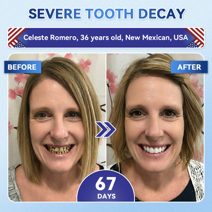 Your Smile~ SpringCherry® 🦷 Tideglusib Fast‑Dissolving Tooth & Gum Repair Oral Strips ✨ (𝟓-𝐢𝐧-𝟏 💎 𝐑𝐞𝐛𝐮𝐢𝐥𝐝 𝐄𝐧𝐚𝐦𝐞𝐥 & 𝐃𝐞𝐧𝐭𝐢𝐧 • 𝐒𝐭𝐫𝐞𝐧𝐠𝐭𝐡𝐞𝐧 𝐆𝐮𝐦𝐬 • 𝐄𝐫𝐚𝐝𝐢𝐜𝐚𝐭𝐞 𝐓𝐚𝐫𝐭𝐚𝐫 & 𝐎𝐝𝐨𝐫 • 𝐖𝐡𝐢𝐭𝐞𝐧𝐢𝐧𝐠 • 𝐒𝐭𝐨𝐩 𝐓𝐨𝐨𝐭𝐡 𝐒𝐞𝐧𝐬𝐢𝐭𝐢𝐯𝐢𝐭𝐲)