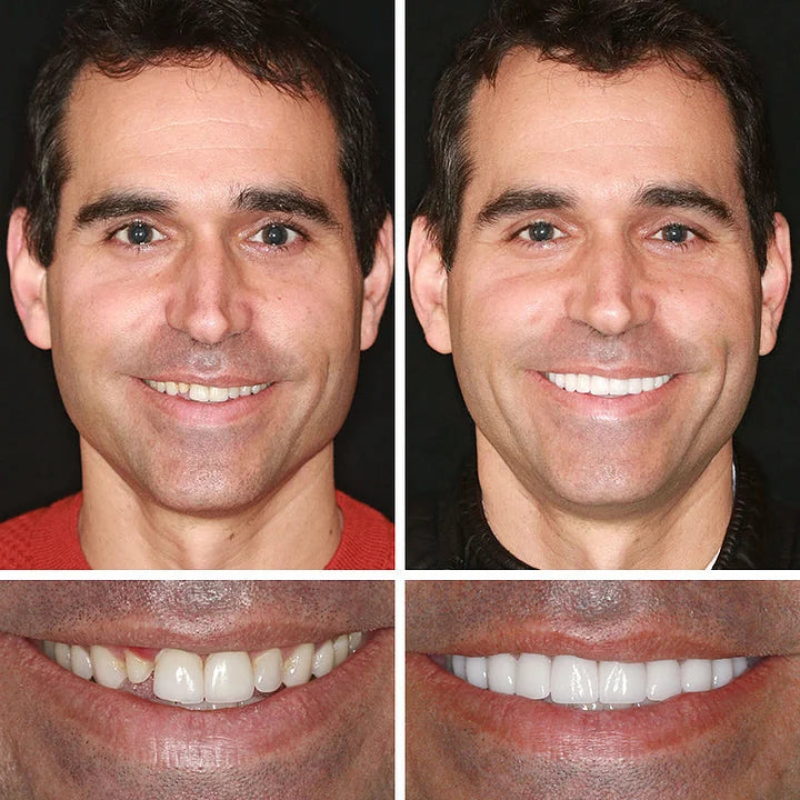 💥Ends Today: 75% OFF! ⏰DarkFairy™ Medical Full Denture with Strong Suctiond Custom-Fit Full Functional Dentures🦷