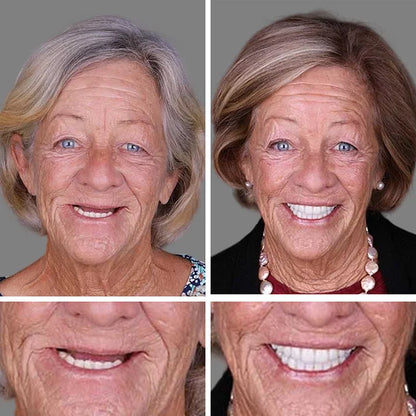 💥Ends Today: 75% OFF! ⏰DarkFairy™ Medical Full Denture with Strong Suctiond Custom-Fit Full Functional Dentures🦷