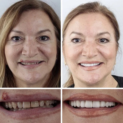 💥Ends Today: 75% OFF! ⏰DarkFairy™ Medical Full Denture with Strong Suctiond Custom-Fit Full Functional Dentures🦷