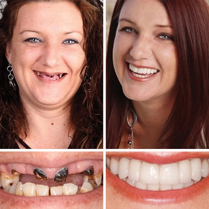 💥Ends Today: 75% OFF! ⏰DarkFairy™ Medical Full Denture with Strong Suctiond Custom-Fit Full Functional Dentures🦷