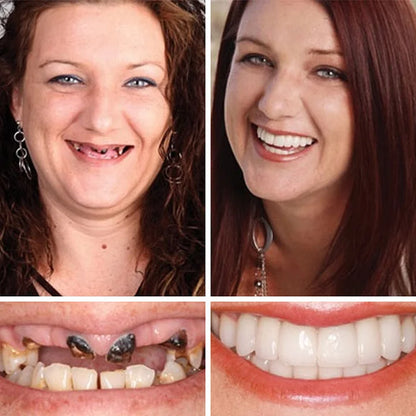 💥Ends Today: 75% OFF! ⏰DarkFairy™ Medical Full Denture with Strong Suctiond Custom-Fit Full Functional Dentures🦷